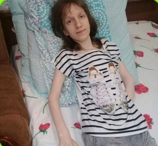 Оксана Близгарева из Волгограда на грани истощения от потери веса