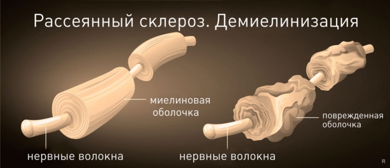 Российские врачи спасают от рассеянного склероза с помощью новых методов лечения