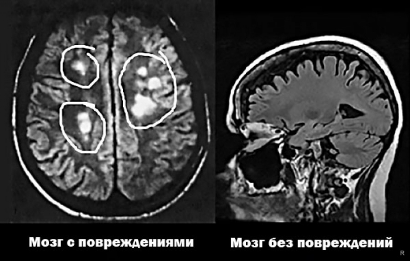 Российские врачи спасают от рассеянного склероза с помощью новых методов лечения