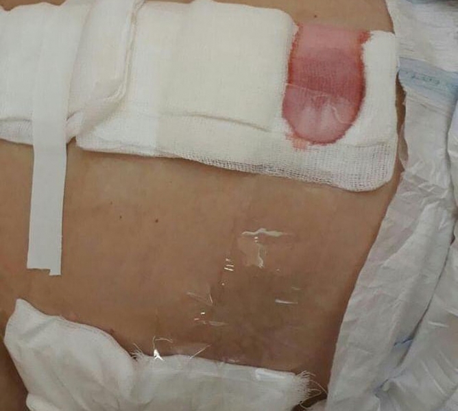 В благовещенской больнице пациентке сделали перевязку скотчем вместо пластыря