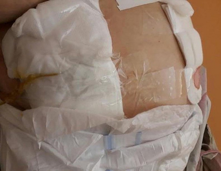 В благовещенской больнице пациентке сделали перевязку скотчем вместо пластыря