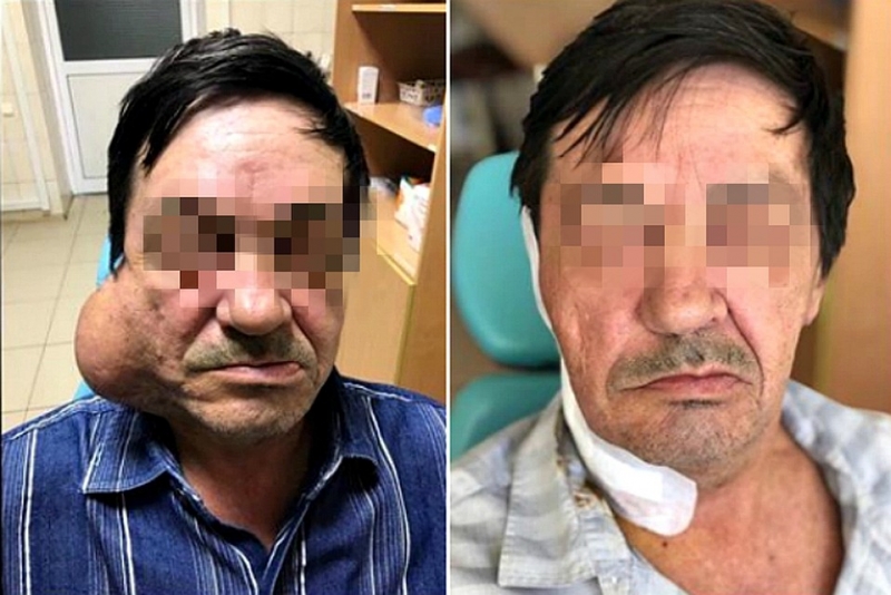 Кубанские хирурги удалили мужчине на лице 10-сантиметровую опухоль