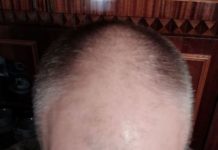 Установлены новые причины облысения Почему происходит облысение?