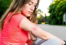 Фибромы после укусов насекомых: как их предотвратить красная фиброма