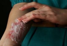 Ожоги – поддержка заживления и наложение повязок ожоги и первая помощь
